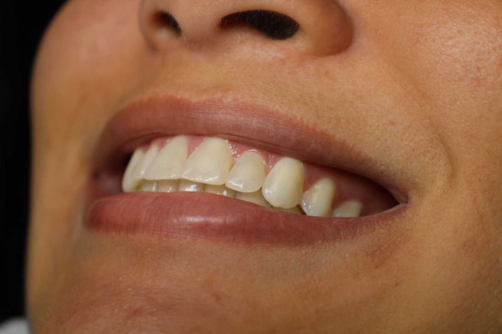 Resultado implante dentário