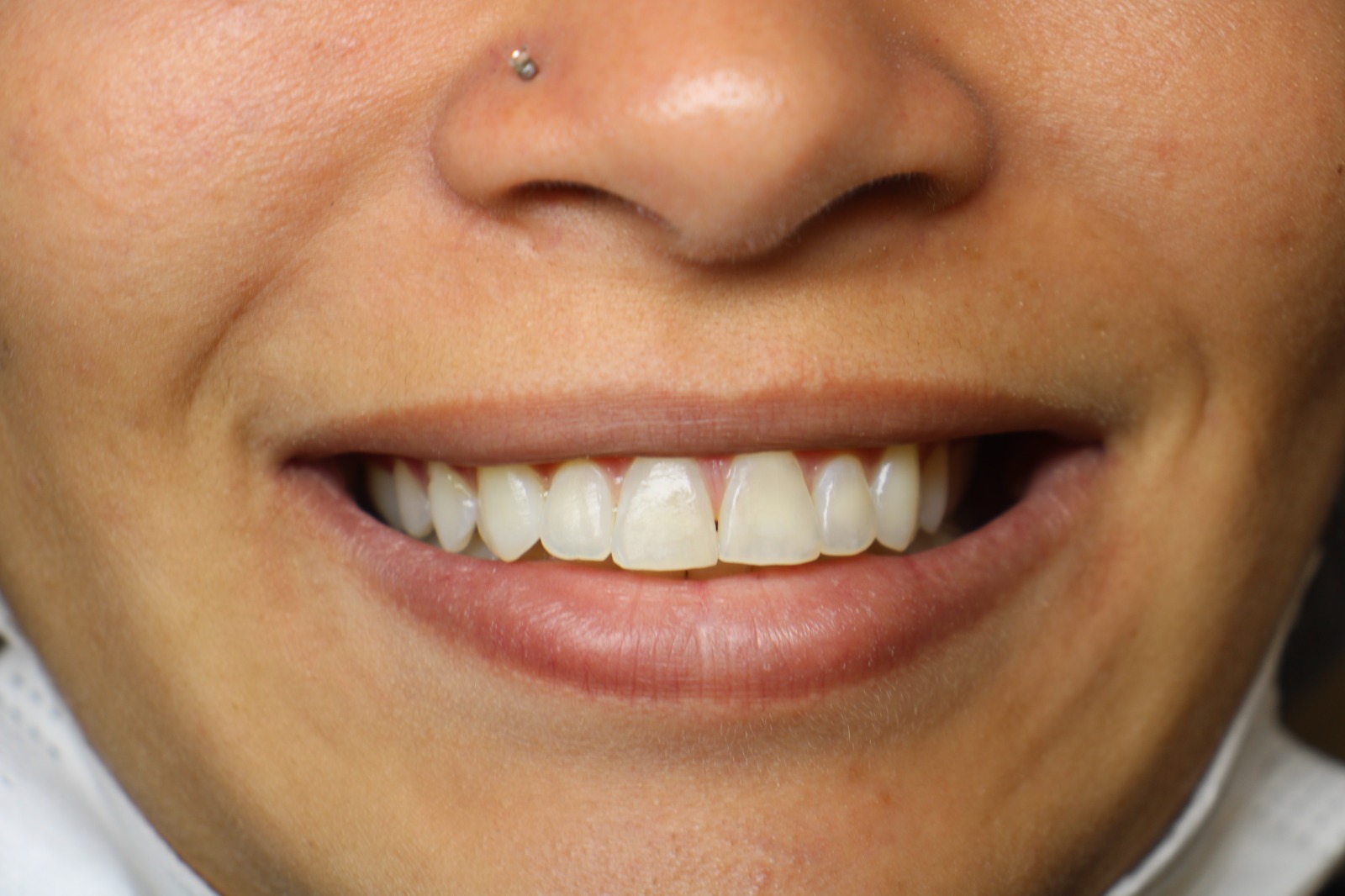 Resultado implante dentário