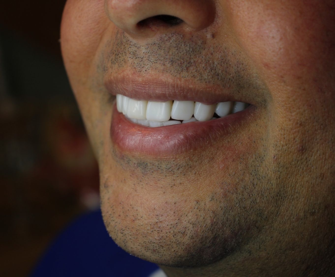 Resultado implante dentário
